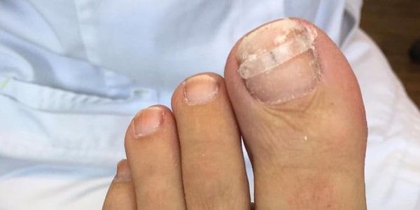 Nagelbeugel­techniek en ingroeiende nagels