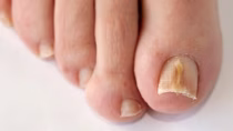 Advies en behandeling schimmelnagels