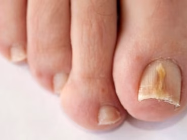 Advies en behandeling schimmelnagels