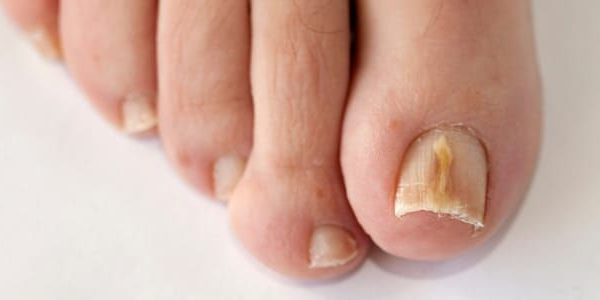 Advies en behandeling schimmel­nagels