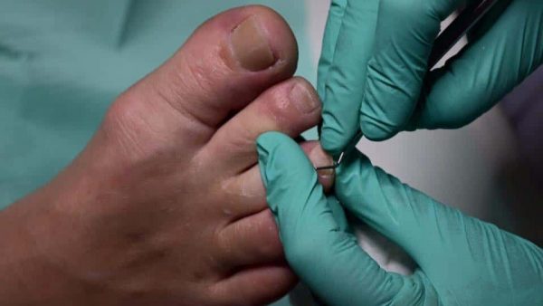 Medische pedicure behandeling van risicovoeten