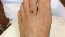 Nagelbeugeltechniek en ingroeiende nagels