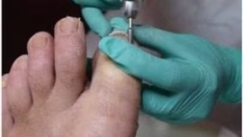 Nagelreparatie
